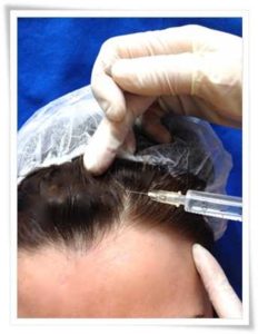 Cure Per Calvizie Ed Alopecia