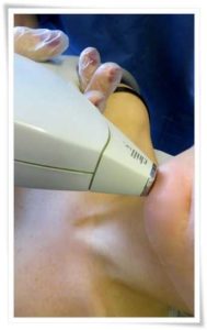 Trattamento Epilazione Laser Viso